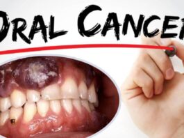 Cancer Symptom: The Condition in The Mouth is Known As Mouth Cancer